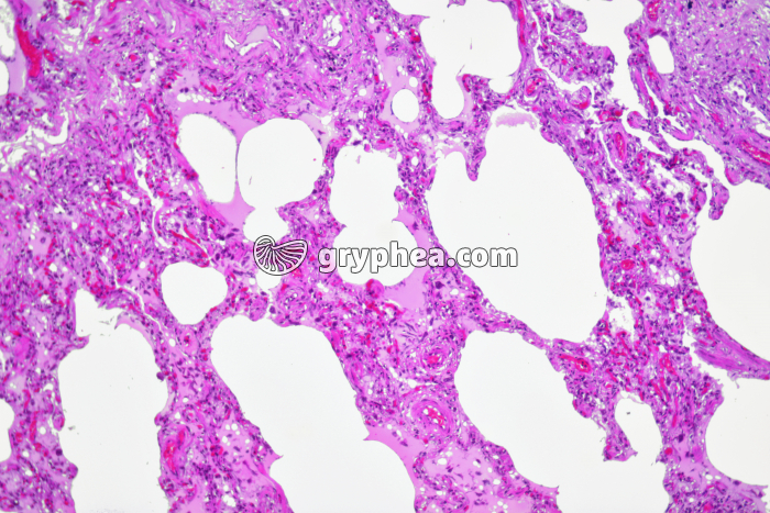 Poumon pathologique - Homme fumeur x25 - gryphea.org